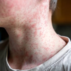 What's the Deal With Measles?