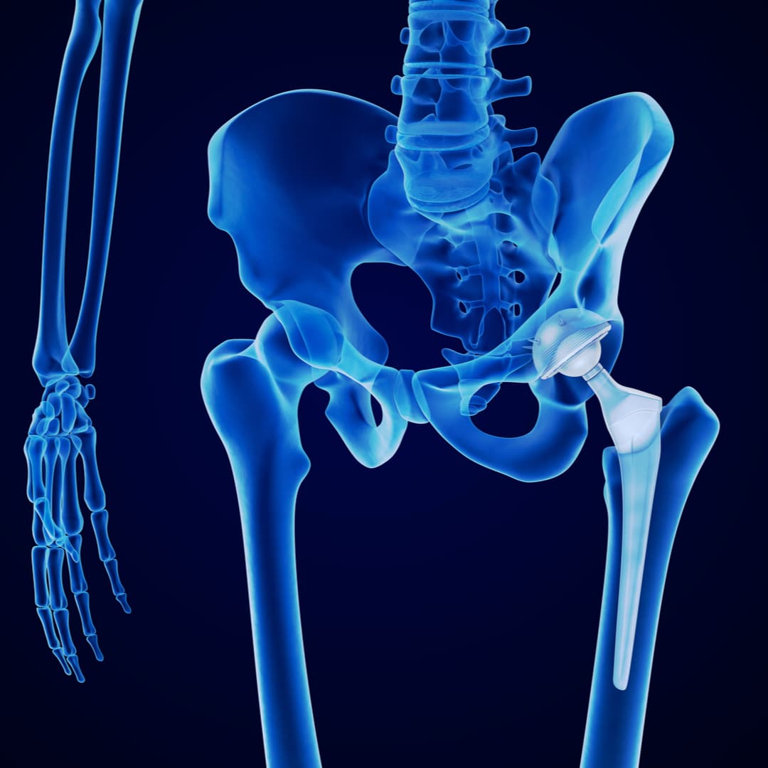 Understand the Benefits of the Anterior Approach to Hip Replacement Surgery