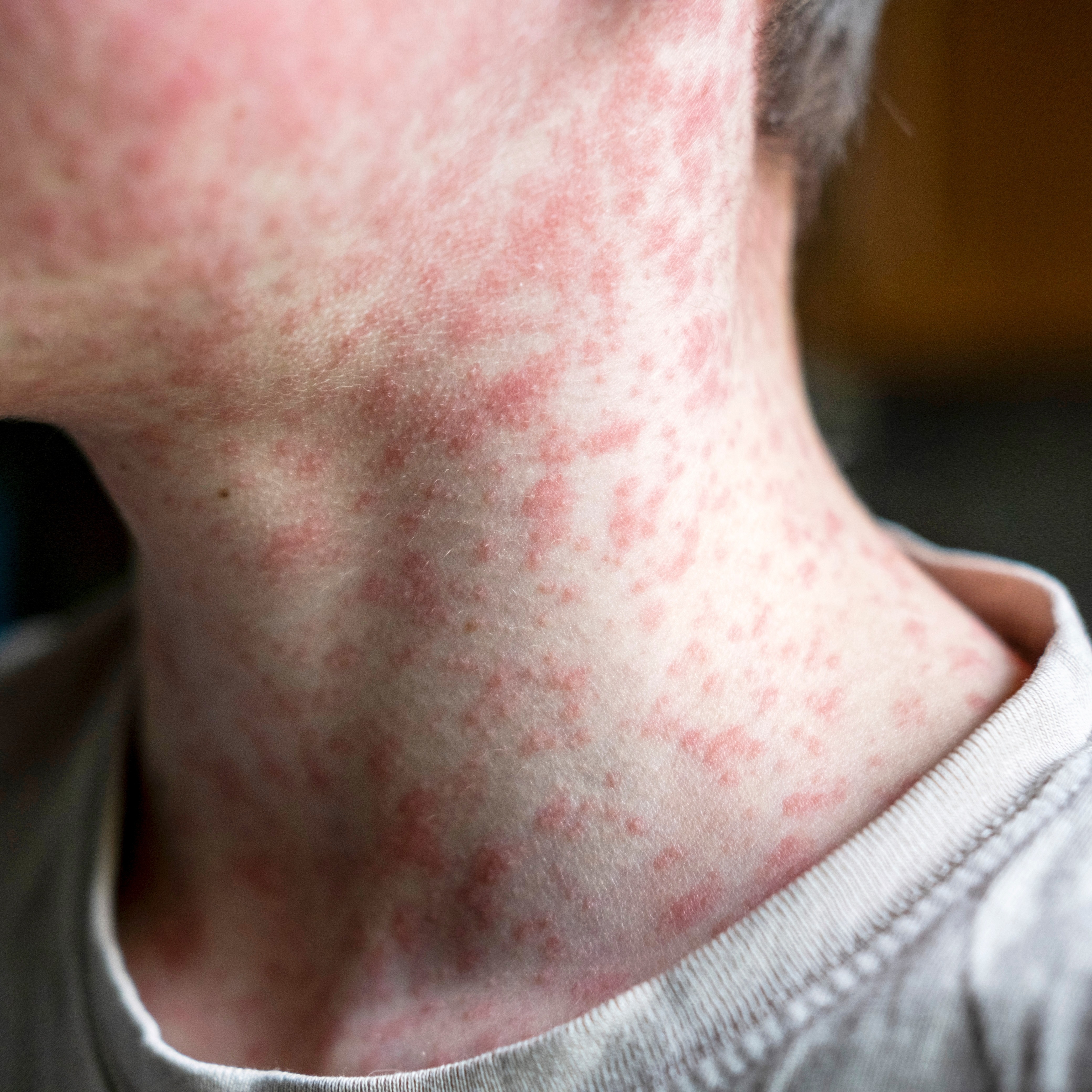 What's the Deal With Measles?