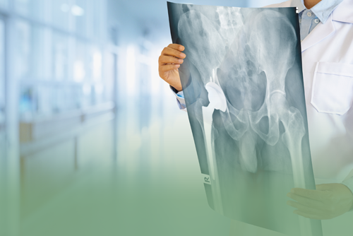 Understand the Benefits of the Anterior Hip Replacement Surgery